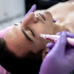 Microneedling treatment at Aesthetics by Thaddeus
