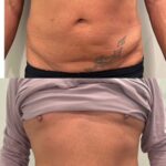 T-Shape body contouring treatment at Aesthetics by Thaddeus
